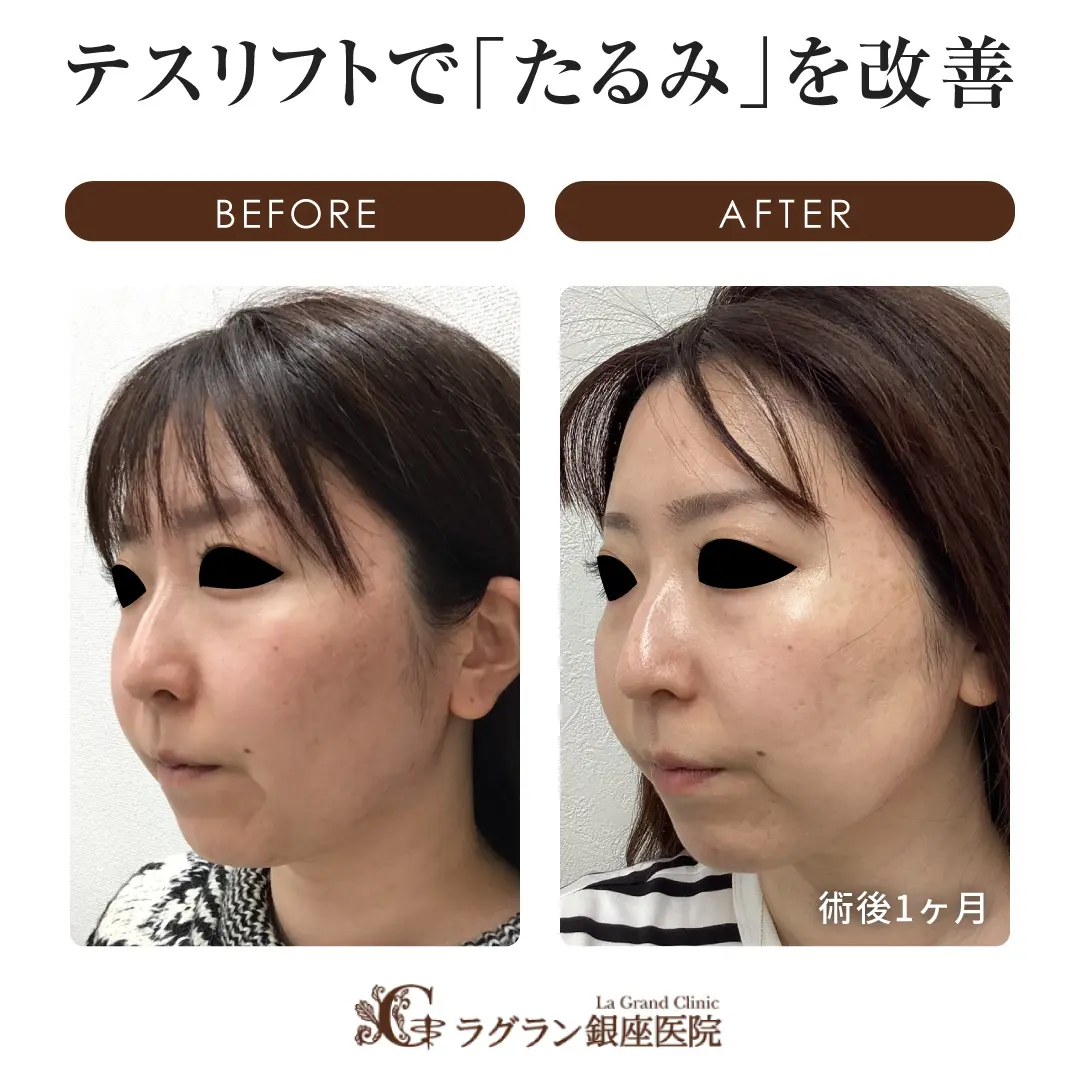 テスリフト