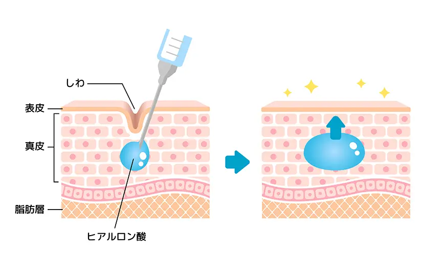 貴族フィラーの仕組み