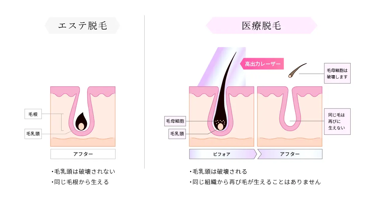 医療脱毛とエステ脱毛の違い